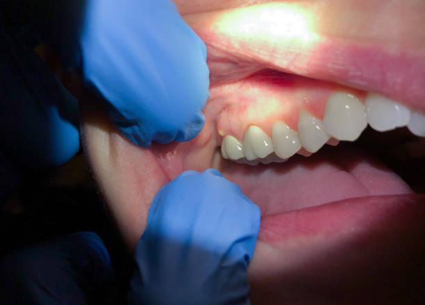 Best Emergency Broken Tooth Repair in Kirkwood, MO